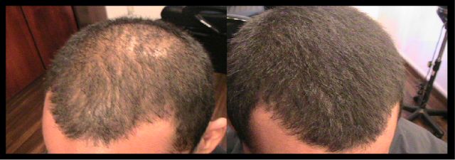 http://trendzhaircare.files.wordpress.com/2011/03/crown-hair-loss-solution.jpg